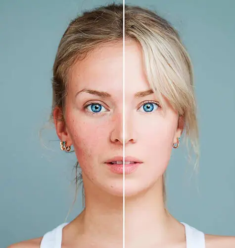 Rosacea Benefits