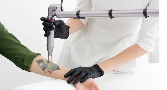 Laser tattoo removal