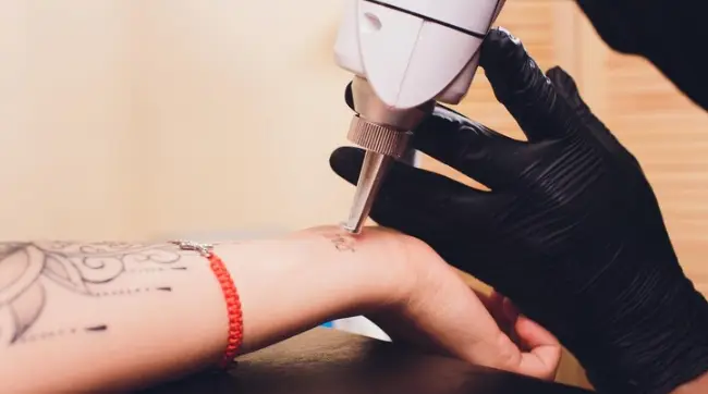 Laser tattoo removal