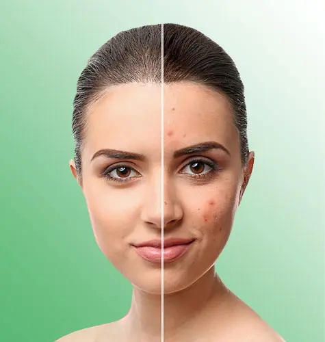 Acne Treatment Desc