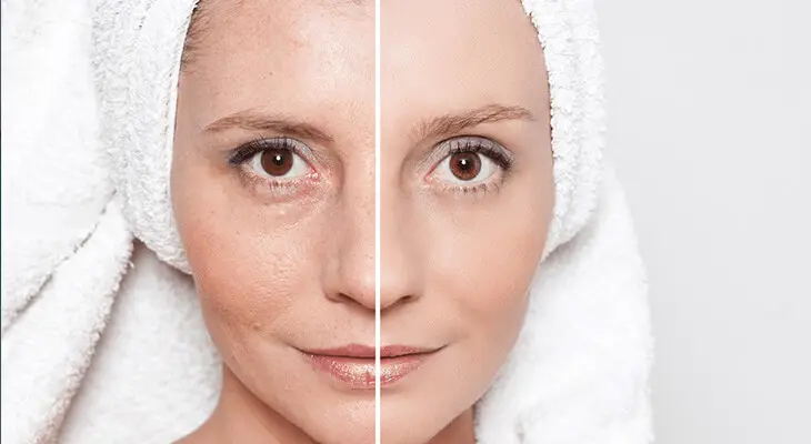 RF Facial vs Facial