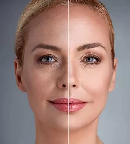 skin resurfacing treatment view