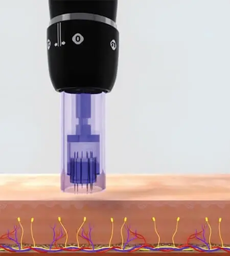 Microneedling treatment procedure view