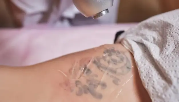 Laser tattoo removal