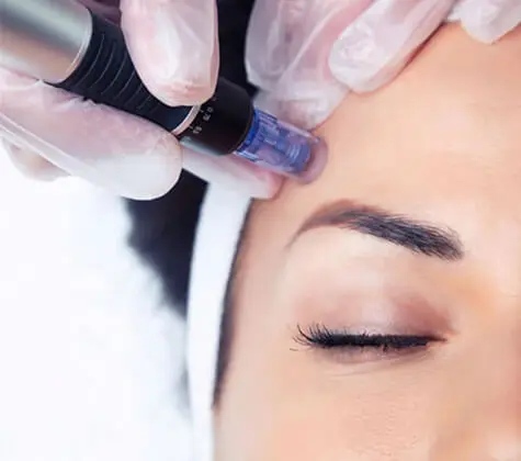 microneedling-dermapen