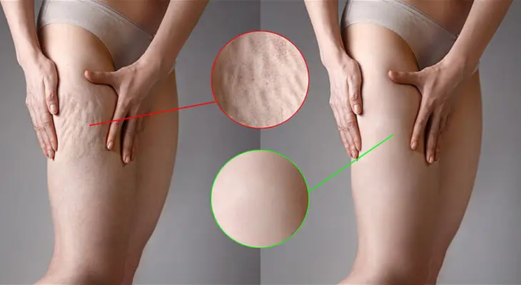 Collagen Lift Before and After