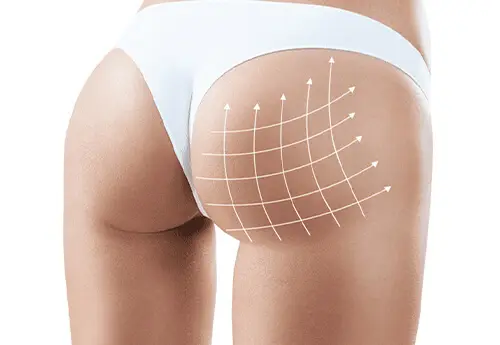 Brazilian Butt Lift Treatment View