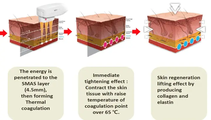 Hifu therapy overview and aftercare