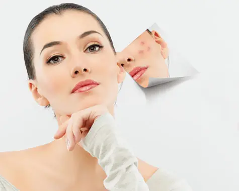 Acne Benefits