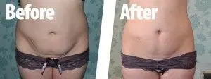 Before After