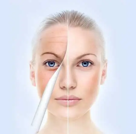 Non Ablative skin resurfacing treatment process on front face view