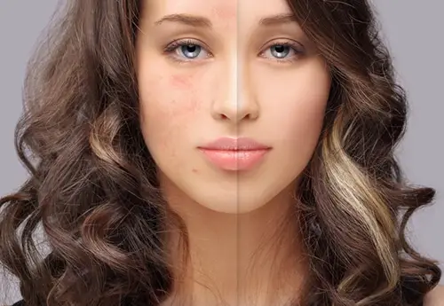 Rosacea laser treatment near me