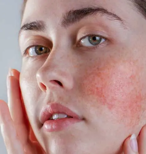 Rosacea Desc