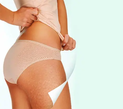 Cellulite Reduction Treatment View