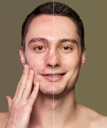 Co2 Laser Resurfacing
