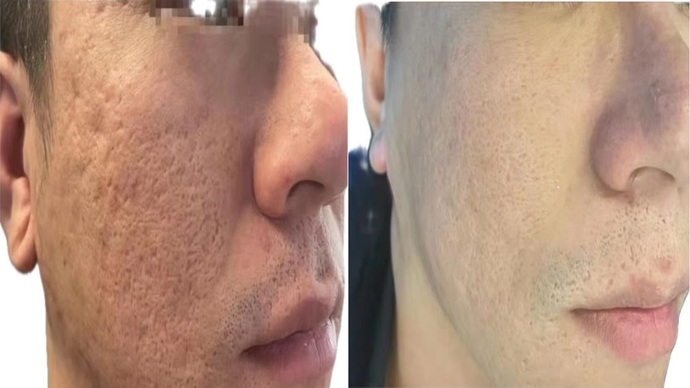 Co2 Laser Resurfacing