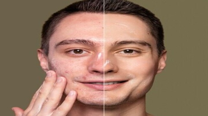 Co2 Laser Resurfacing 2