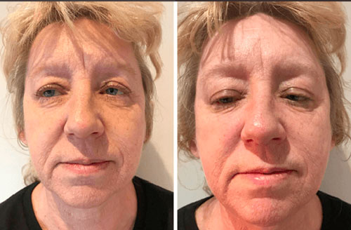 4d Hifu Facial Treatment Before And After 1