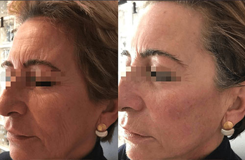 4d Hifu Facial Treatment Before And After 2