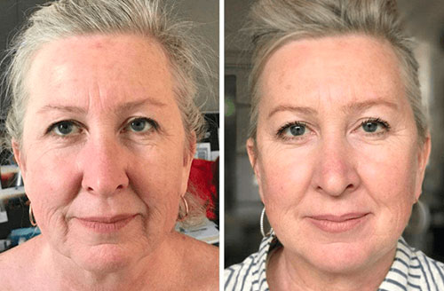 4d Hifu Facial Treatment Before And After 3