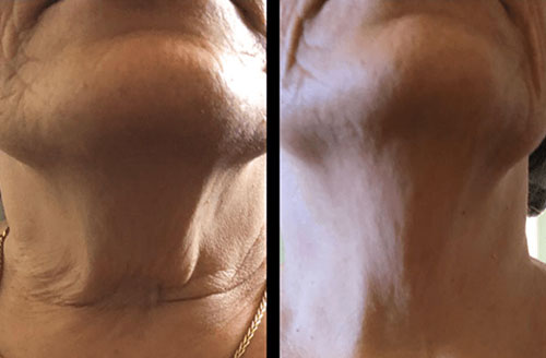 4d Hifu Facial Treatment Before And After 4