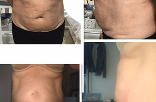 4d Hifu Facial Treatment Before And After 5