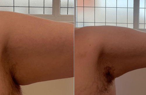4d Hifu Facial Treatment Before And After 6