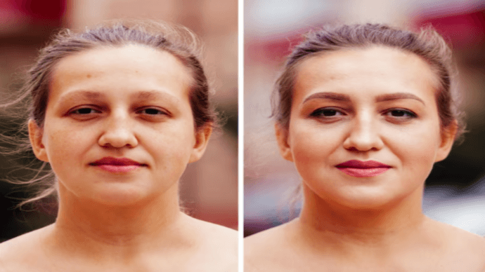 Carbon Laser Facial Before After