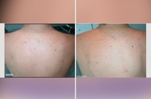 Acne Treatment 1