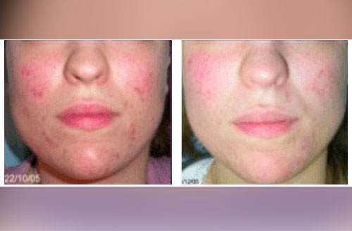 Acne Treatment 2