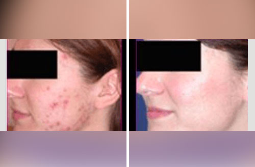 Acne Treatment 3