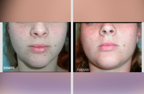 Acne Treatment 4