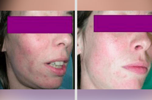 Acne Treatment 5