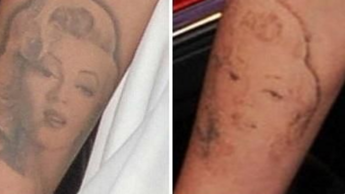 Laser tattoo removal