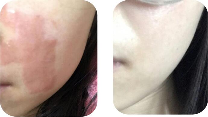 Co2 Laser Resurfacing