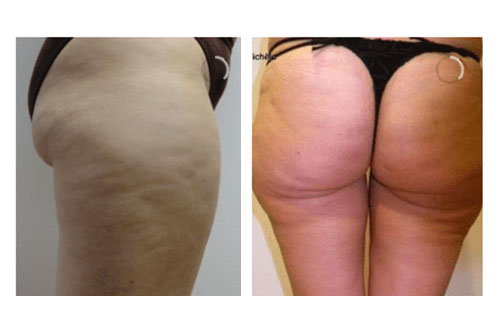 Brazilian Butt Lift Treatment before and after 2
