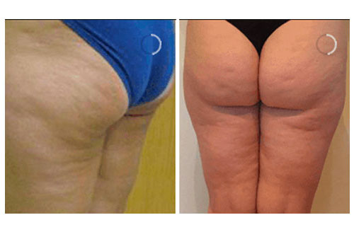 Brazilian Butt Lift Treatment before and after 1