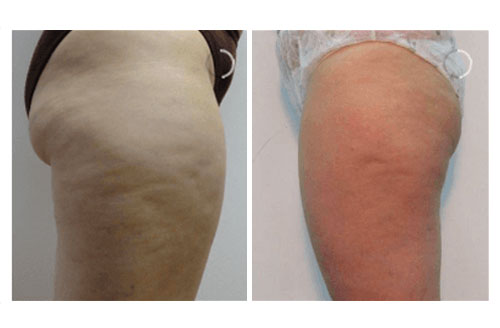 Cellulite Reduction Treatment Before And After 2