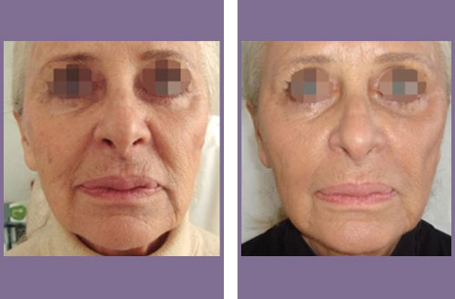 Dermal Volumising micro needling acne scars before and after