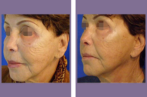 micro needling acne scars before and after