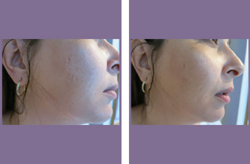 Dermal Volumising micro needling acne scars before and after