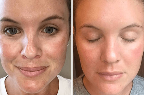 micro needling acne scars before and after