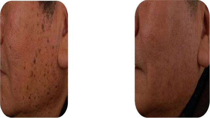 Co2 Laser Resurfacing