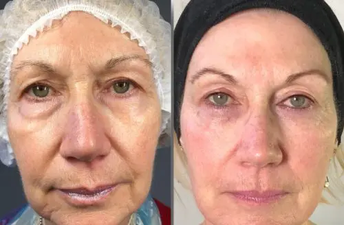 Geneo Plus Before and After