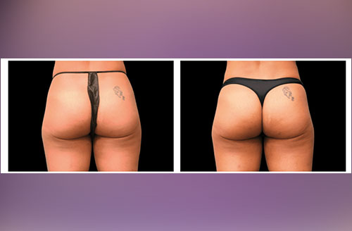 Muscle Tone & Body Contouring Before And After 2