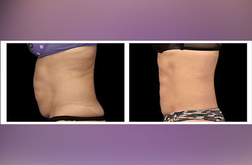 Muscle Tone & Body Contouring Before And After 3