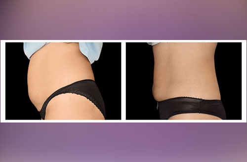 Muscle Tone & Body Contouring Before And After 4