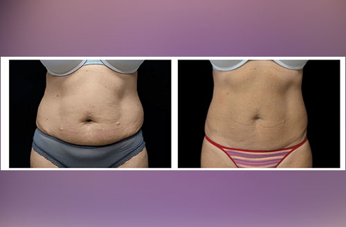 Muscle Tone & Body Contouring Before And After 5