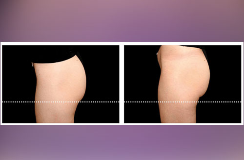 Muscle Tone & Body Contouring Before And After 6