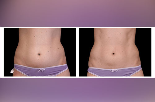 Muscle Tone & Body Contouring Before And After 1